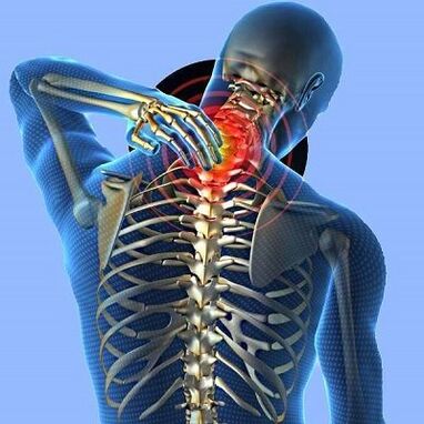 Болка во вратот со остеохондроза на грлото на матката