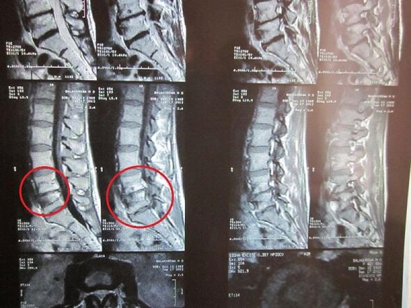 Дијагноза на остеохондроза на грлото на матката