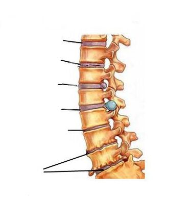 Како се развива остеохондрозата