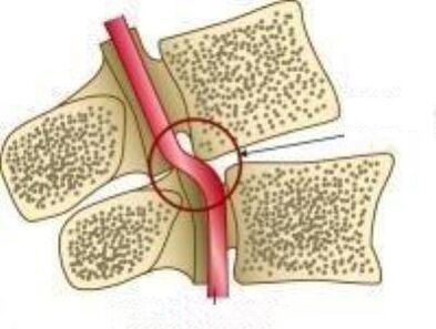 Синдром на ваил артерија