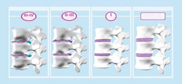 Фази на остеохондроза на грлото на матката