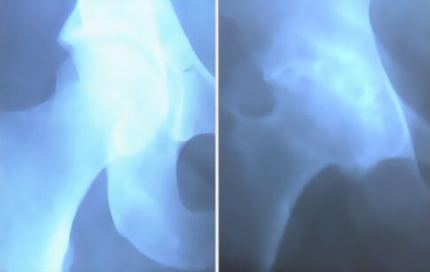 Ѓубриња на артроза на зглобот на коленото