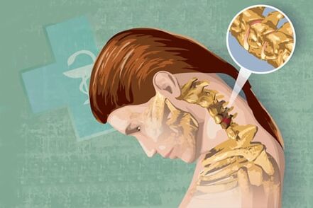 Рефлексни симптоми на остеохондроза